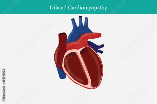 Types of heart diseases: dilated cardiomyopathy. illustration for medical use. eps 10