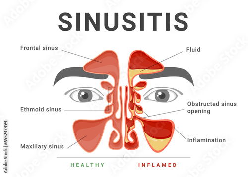 Sinusitis healthy and inflammatory educational medical infographic scheme banner vector flat