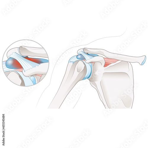 Subacromial bursitis of the shoulder. Medically Illustration. Labeled