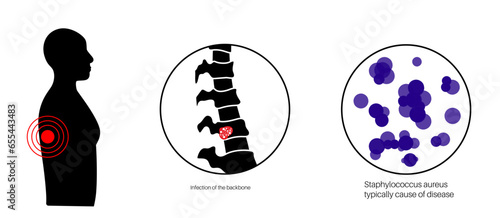 Vertebral osteomyelitis poster