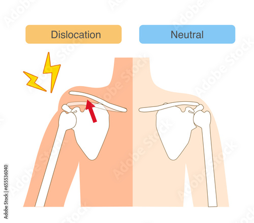 Characteristics and Comparative Diagram of Acromioclavicular Joint Dislocation Piano Key Signs