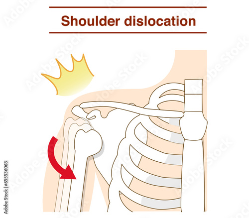 Mechanism of shoulder joint dislocation