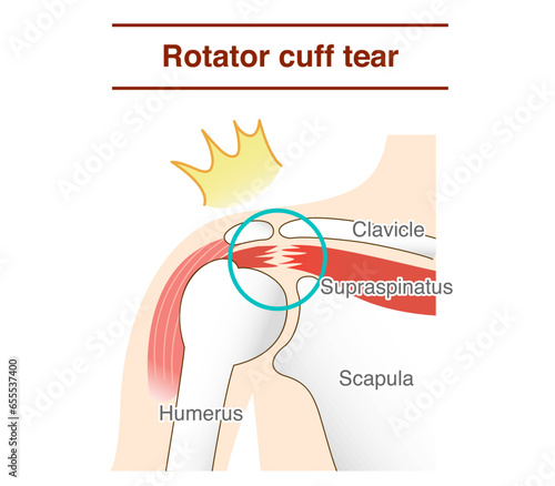 How and why shoulder rotator cuff tears occur