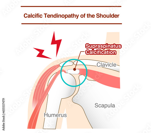 Causes and Mechanisms of Calcific Rotator Cuff Inflammation