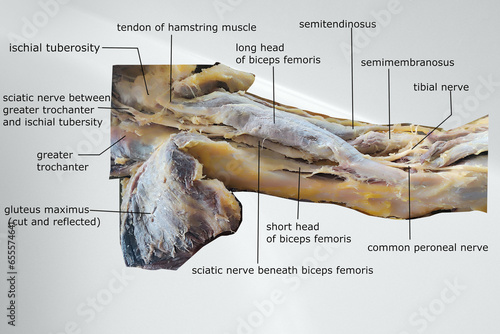 dissection image of the muscle of the thigh with showing sciatic nerve and popliteal fossa photo