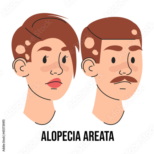 Alopecia areata vector isolated. Male and female character suffering from hair loss. Problems with health. Medical condition.