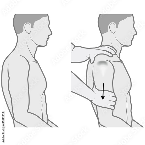Shoulder Examination. Sulcus Sign Test. Illustration Is Part Of Series Shoulder Examination. Illustration