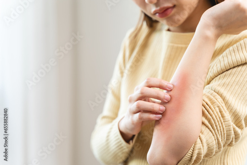 young woman scratching on her arm and has a red rash irritation on her skin from dust intolerance. photo