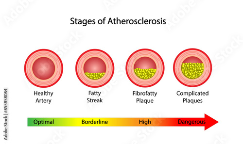 Atherosclerosis Stages, normal artery versus narrowed artery blocked with cholesterol plaque. Blood vessel blocked with a clot. High cholesterol level as atherosclerotic risk. Vector design.