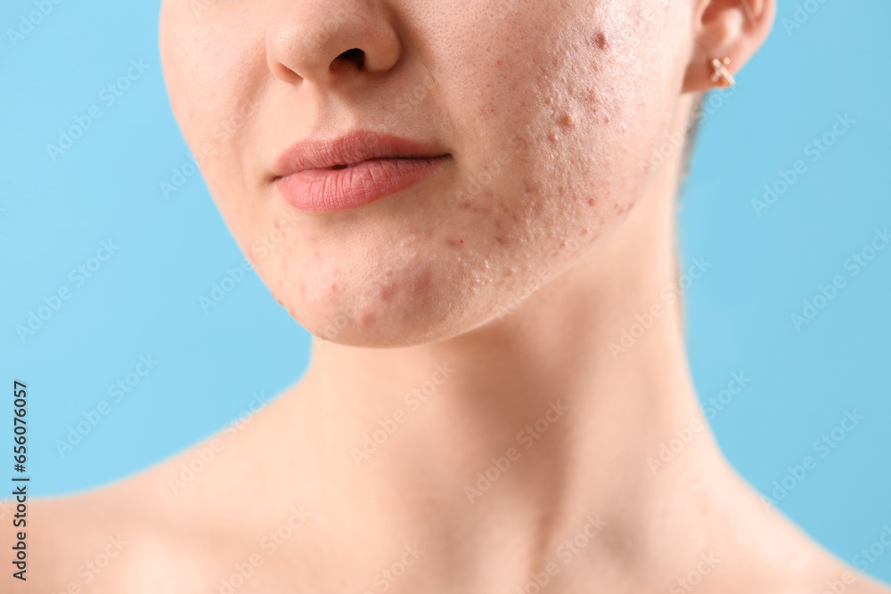 Obraz premium Teenage girl with acne problem on blue background, closeup