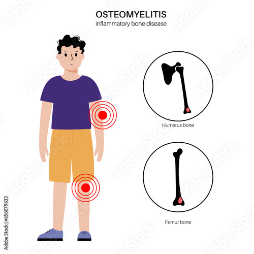 Osteomyelitis in children