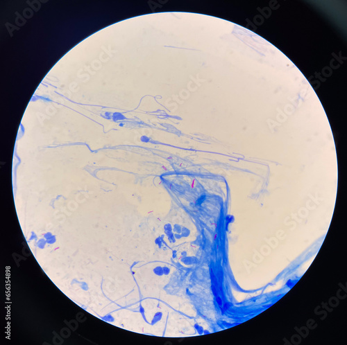 Mycobacterium tuberculosis.AFB positive 3+. photo