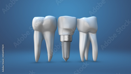 Animation of the dental implants