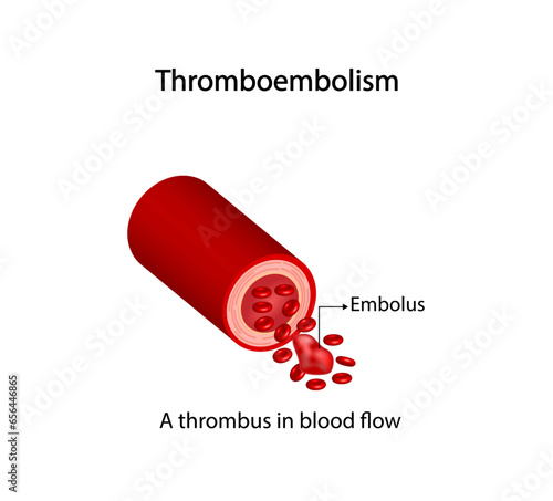 Thromboembolism. Circulating blood clot. Normal blood flow and a thrombus in blood flow, embolus. Red blood cells. Vector illustration.	