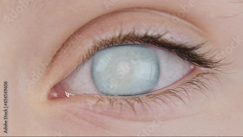 Corneal opacity of human eye. Cloudy area in the lens of eyeball in close-up