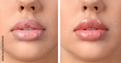 Photography Young woman before and after treatment of dry lips, closeup