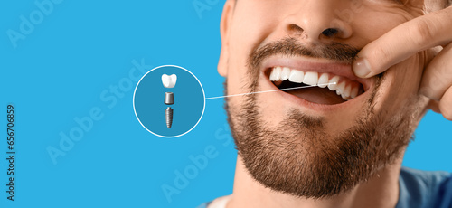 Young man with implanted to...