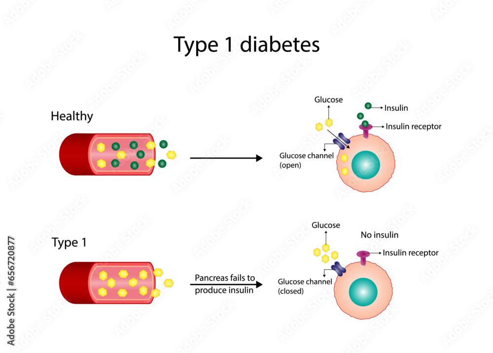Diabetes mellitus type 1, pancreas's failure to produce enough insulin