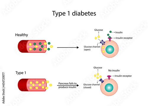 Diabetes mellitus type 1, pancreas's failure to produce enough insulin and type 2, cells fail to respond to insulin (Insulin resistance). Result in high blood glucose levels. Vector illustration