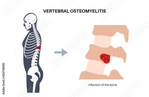 Vertebral osteomyelitis poster