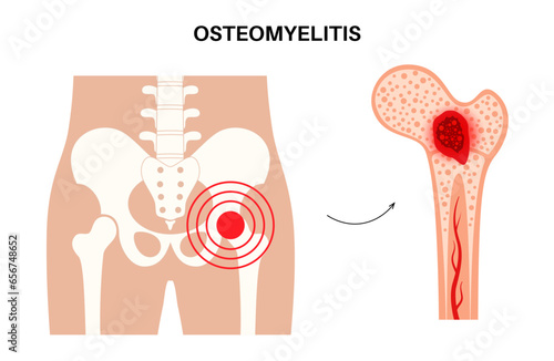 Osteomyelitis of hip