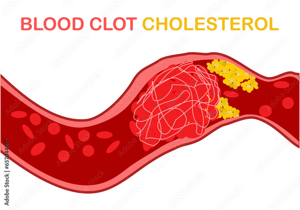 cholesterol in the blood, the cholesterol and other substances may form
