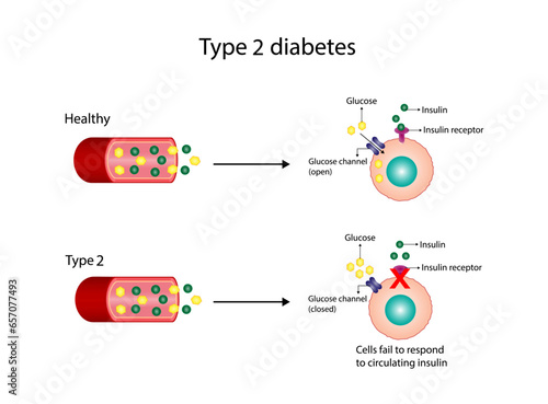 Diabetes mellitus type 2, cells fail to respond to insulin (Insulin resistance). high blood glucose levels. Vector Diagram illustration.