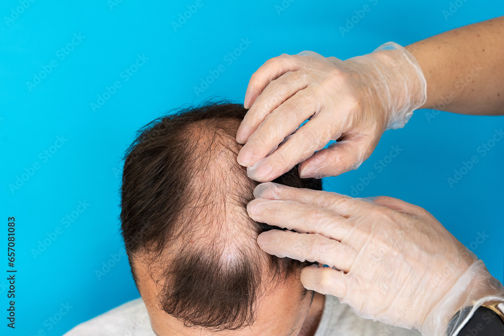 Fototapeta premium Baldness, a man is examined by a doctor in gloves on a blue background close-up.