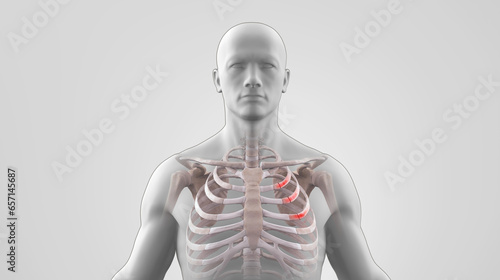 Human skeleton with fractured ribs