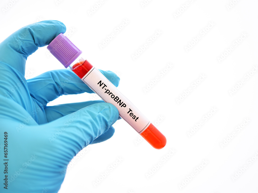 Blood sample tube for NTproBNP test, cardiac marker for acute or