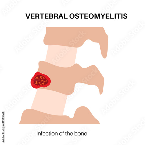 Vertebral osteomyelitis poster