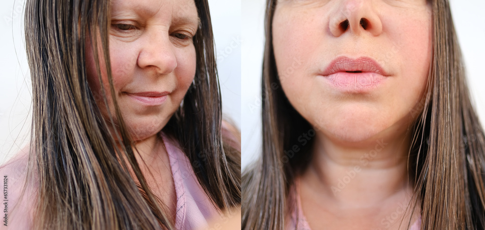 close-up part of female face of woman 40-50 years old with age wrinkles, facial wrinkles before and after treatment, concept of cosmetics, lip augmentation, correction surgery, cosmetic procedures close-up part of female face of woman 40-50 years old with age wrinkles, facial wrinkles before and after treatment, concept of cosmetics, lip augmentation, correction surgery, cosmetic procedures