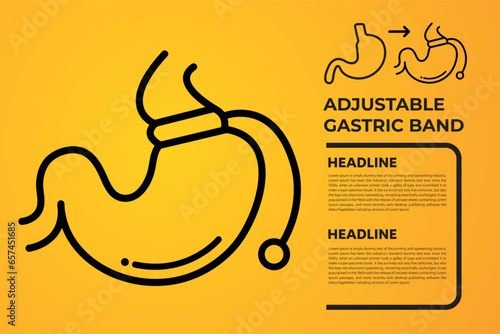 Illustration of Adjustable Gastric Band devise Weight Loss Surgery vector
