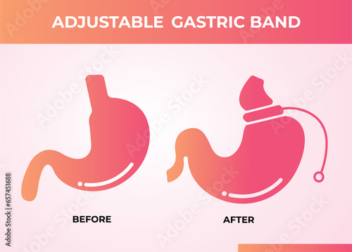 Illustration of Adjustable Gastric Band devise Weight Loss Surgery vector
