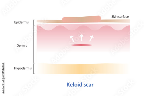 Keloid scar on skin surface vector illustration isolated on white background. Cross section of keloid scar spread beyond the borders of the initial injury, showing overgrowth of scar margin.