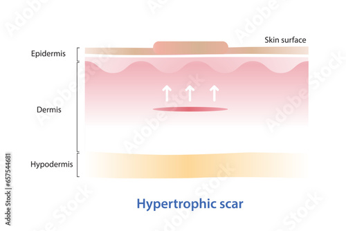 Hypertrophic scar on skin surface vector illustration isolated on white background. Cross section of hypertrophic scar is limited to the area of damaged skin, with raised features within scar margin.