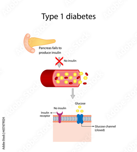 Diabetes mellitus type 1, pancreas's failure to produce enough insulin and type 2, cells fail to respond to insulin (Insulin resistance). Result in high blood glucose levels. Vector illustration