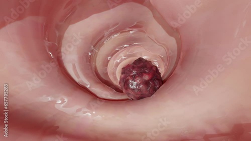 Colorectal cancer, malignant tumor in intestine, Endoscope inside colonoscopy, gut intestine, Colon polyp removal, colonic polyps search, Polypectomy, intestinal carcinoma, bowel neoplasia, 3d render  photo