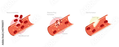 3D Isometric Flat  Conceptual Illustration of Hemostasis, Wound Healing Process Stages, Vasoconstriction and Clot Formation photo