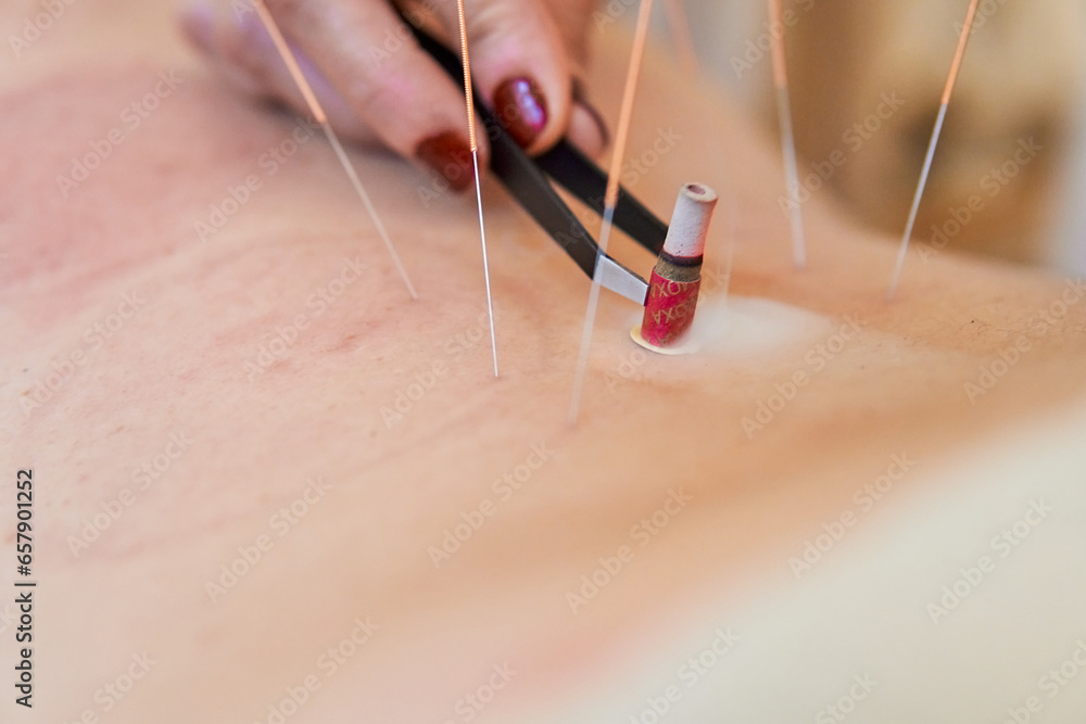 Acupuncturist removing burning moxa of the skin of the patient with tweezers while smoke sticks to the surface
