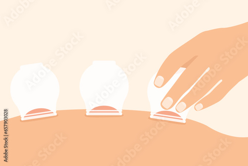 medical cupping therapy on the back- vector illustration
