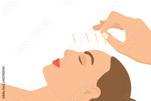 young beauty woman during procedure of acupuncture therapy- vector illustration