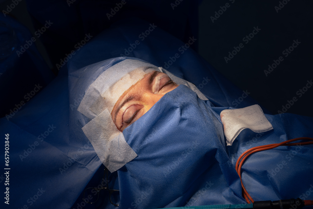 close-up eyes after eye surgery , blepharoplasty operation, plastic surgeon - obrazy, fototapety, plakaty 
