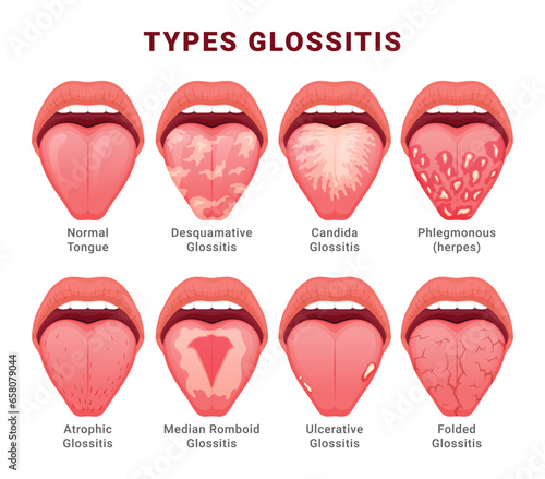 Glossitis type candidiasis of tongue thrush inflammation educational poster with names vector flat