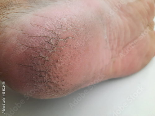 Heel fissures, or cracked heels, happen when the skin on the bottom of your heel becomes hard and dry. Isolated on white background
