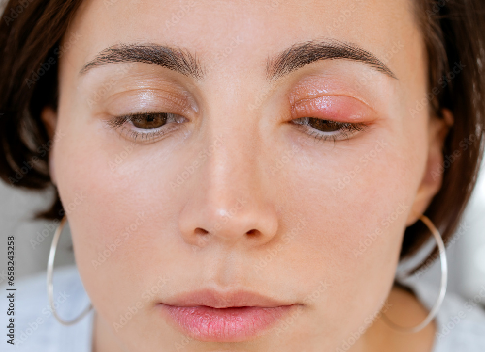 Close up female patient's infected eye. The browneyed woman staring at