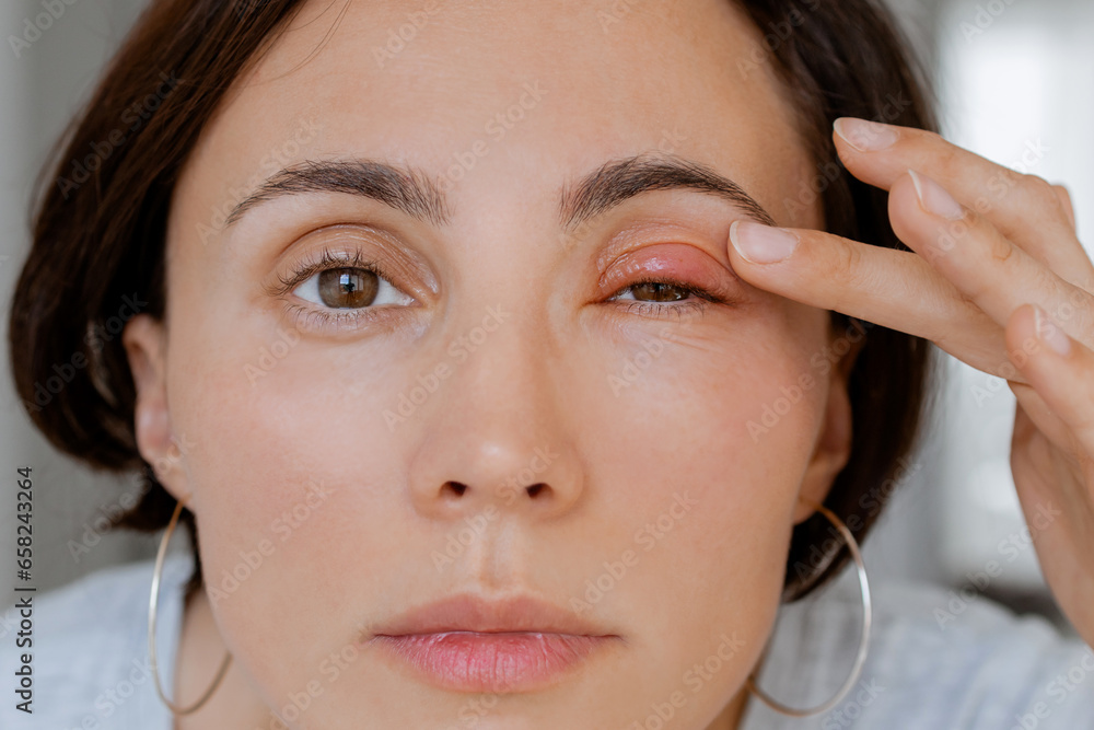Close up female patient's infected eye. The brown-eyed woman staring at