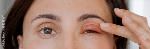 Close up female patient's infected eye. The brown-eyed woman staring at the camera has an external stye bacterial infection. Hordeolum on upper eyelid. Viral Infection. Staphylococcus. Ophthalmology