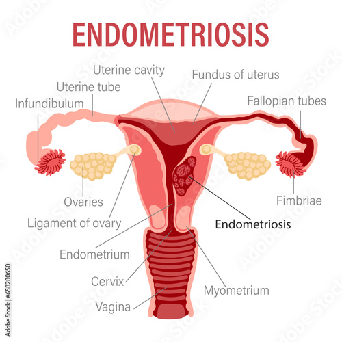 Endometriosis, schematic illustration of the uterus, diseases of the female reproductive system. Medical infographic banner. Vector