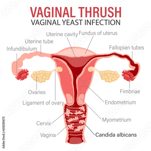 Diseases of the female reproductive system, vulvovaginal candidiasis or vaginal yeast infection. Medical infographic banner. Vector